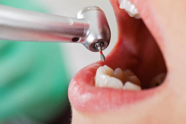 Best Emergency Tooth Extraction in Spurgeon, TN
